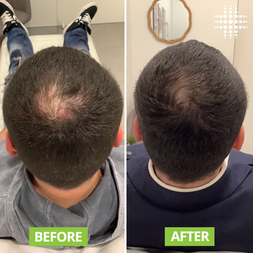 Advanced Hair Growth Serum | 3% Redensyl + 4% Anagain + 3% Baicapil + 1% Capilia Longa | 214% Hair Growth in 10 Days, 89% Hair Loss Reduction