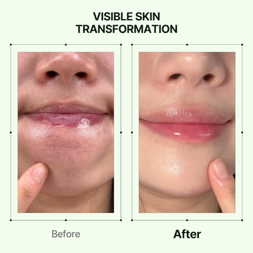 Orien Soothing Spray Toner for Spotless Skin - Removes Acne, Fades Dark Spots, Reveals Glow